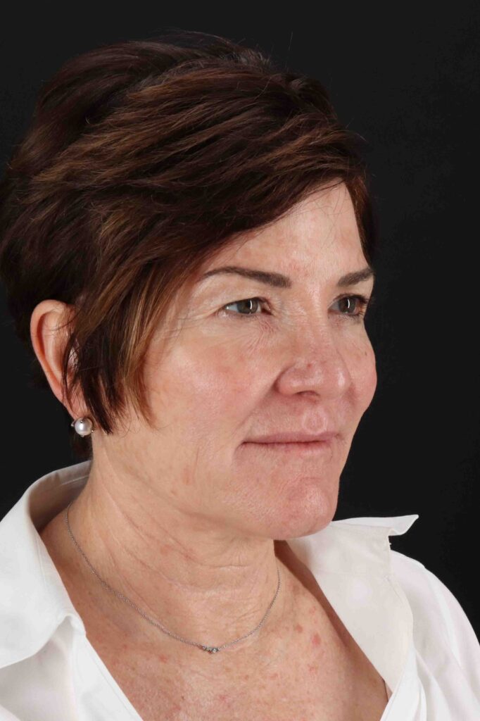 Before - right_oblique