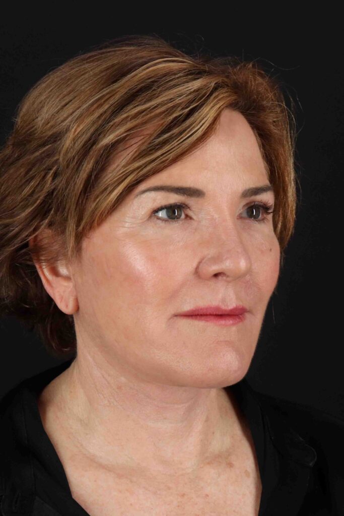 After - right_oblique