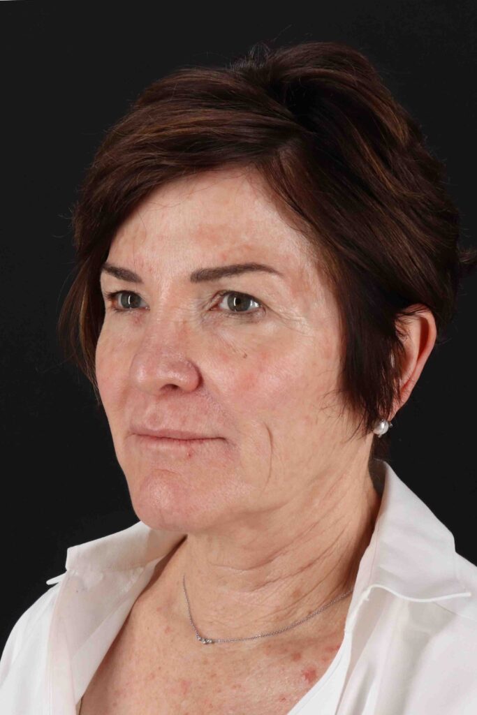 Before - left_oblique