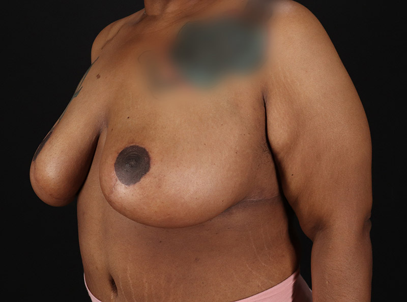 Before - left_oblique