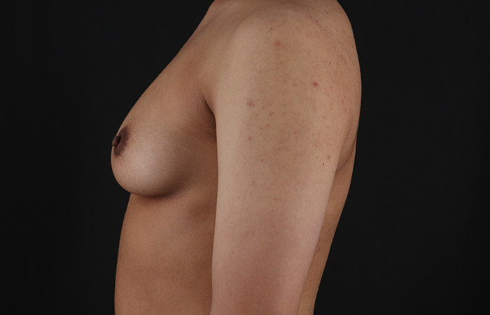 Before - left_lateral