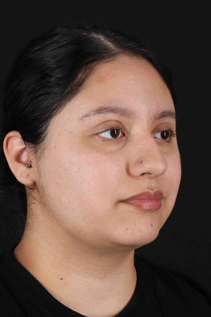 After - right_oblique