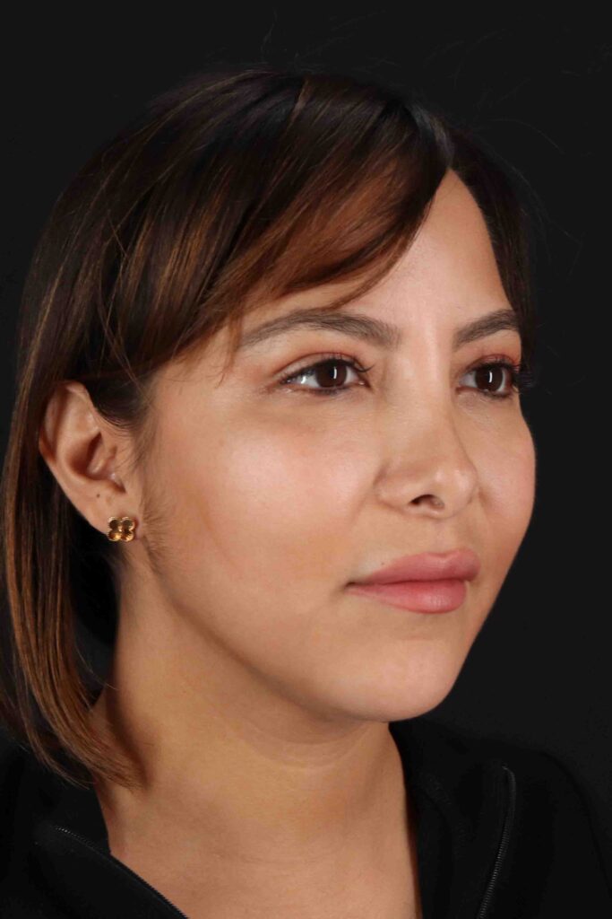 After - right_oblique