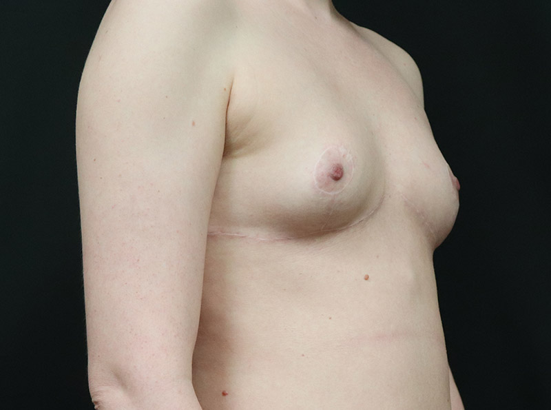 After - right_oblique