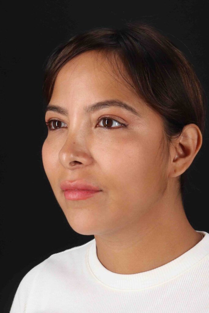 Before - left_oblique