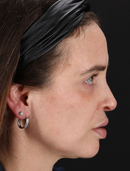 Before - right_lateral