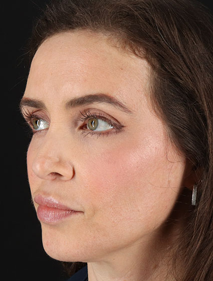 After - left_oblique