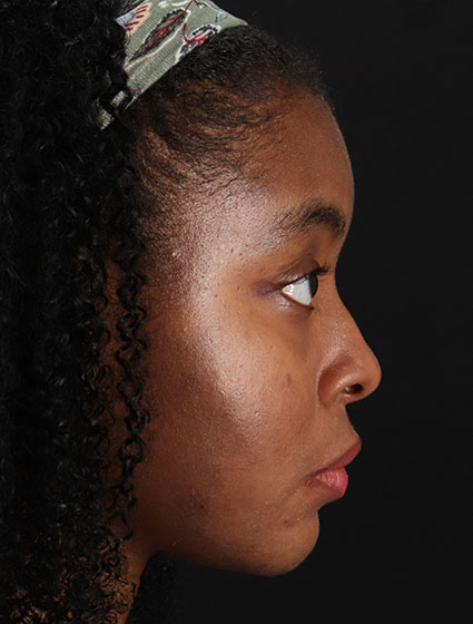 After - right_lateral