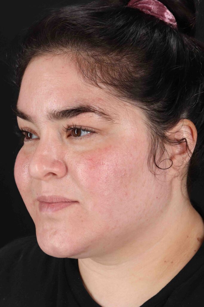 Before - left_oblique