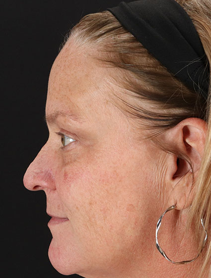 Before - left_lateral