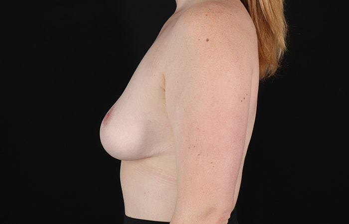 After - left_lateral