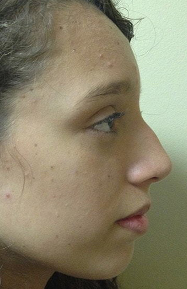 Before - right_lateral