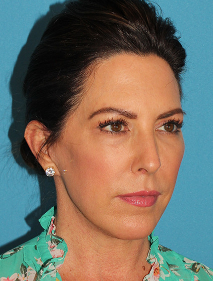 After - right_oblique