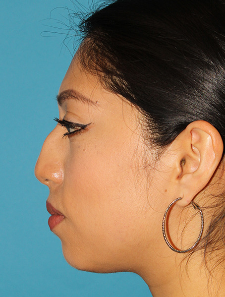 Before - left_lateral