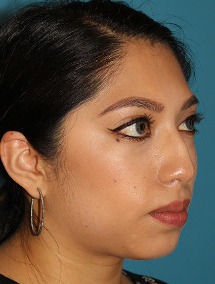 Before - right_oblique