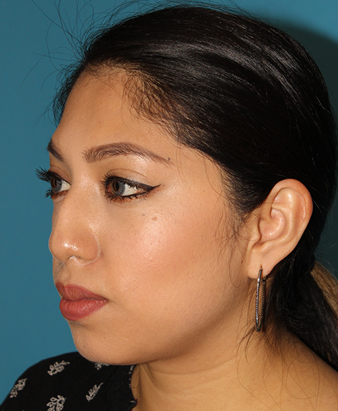 Before - left_oblique