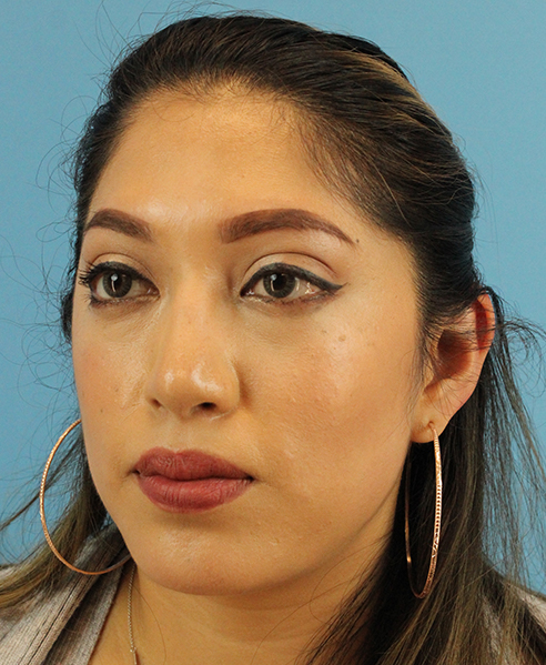 After - left_oblique