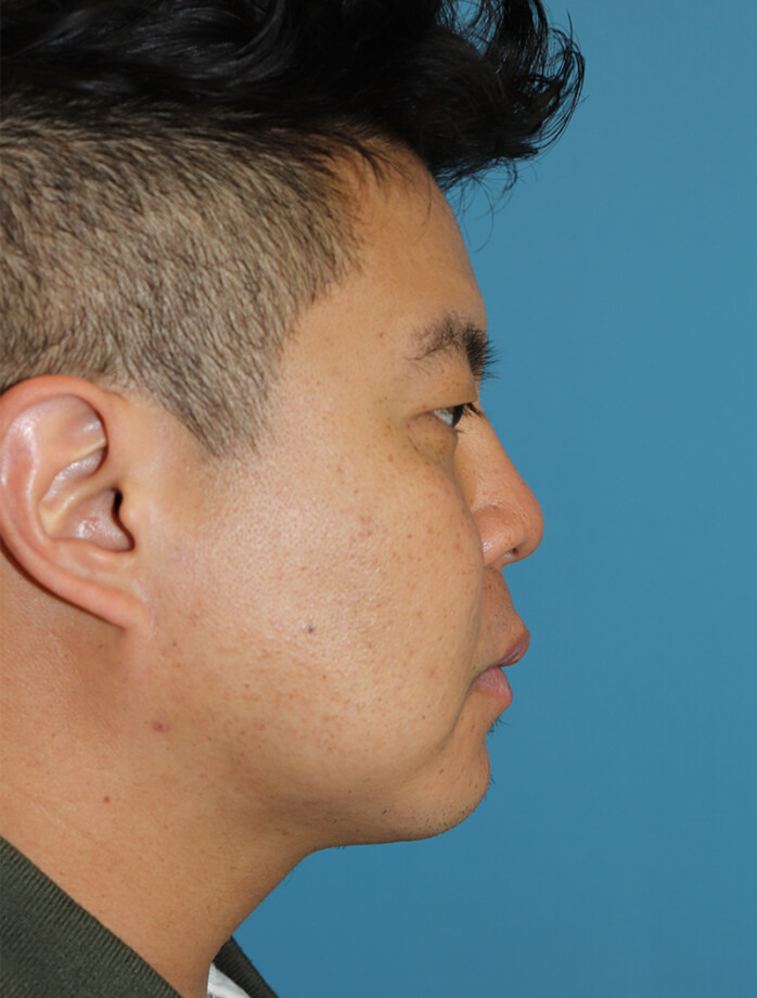 After - right_lateral