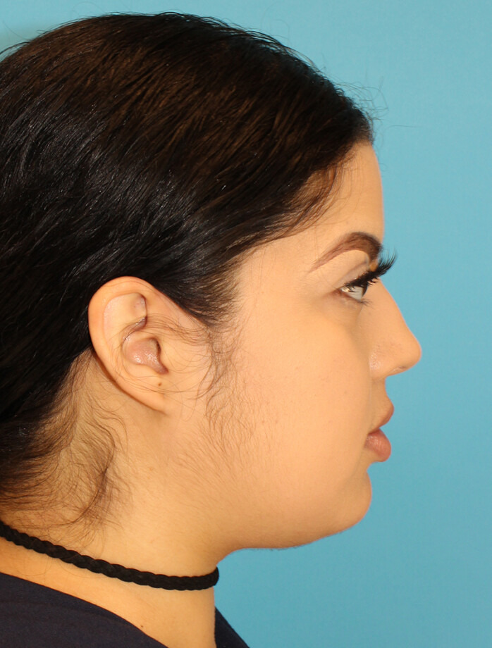 Before - right_lateral