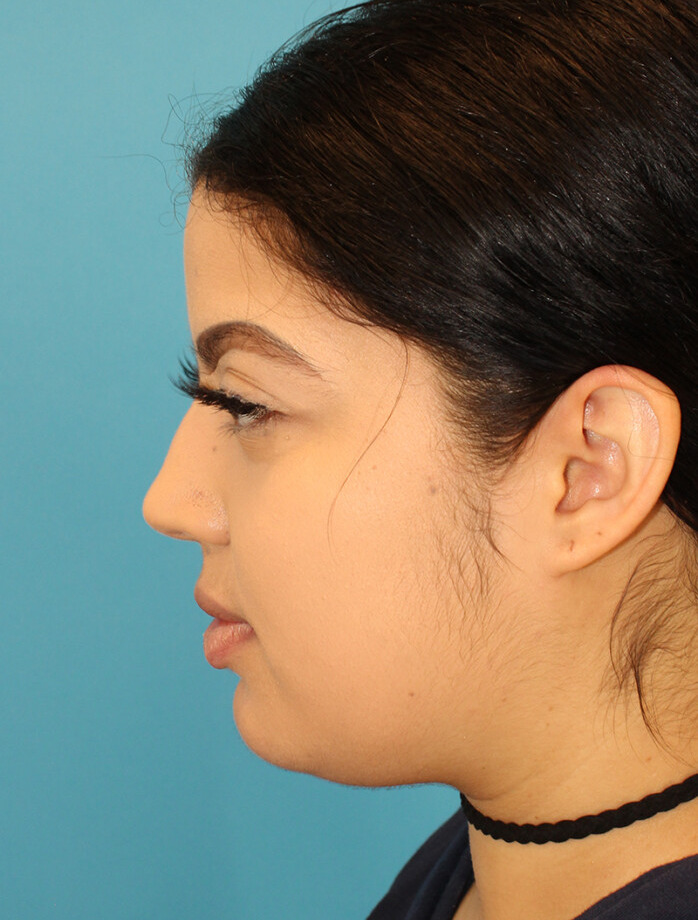 Before - left_lateral