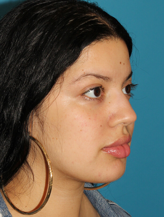 After - right_oblique