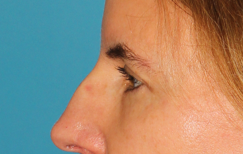 Before - left_lateral