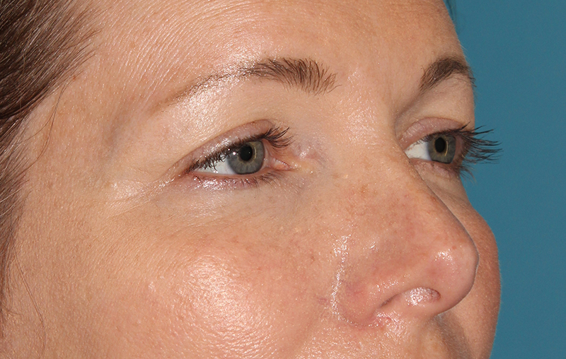 Before - right_oblique