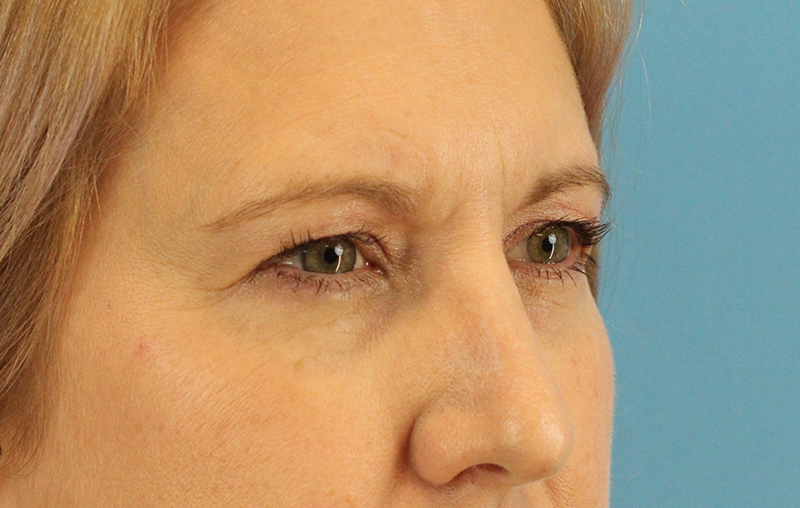 Before - right_oblique