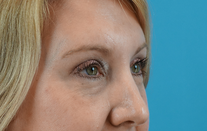 After - right_oblique