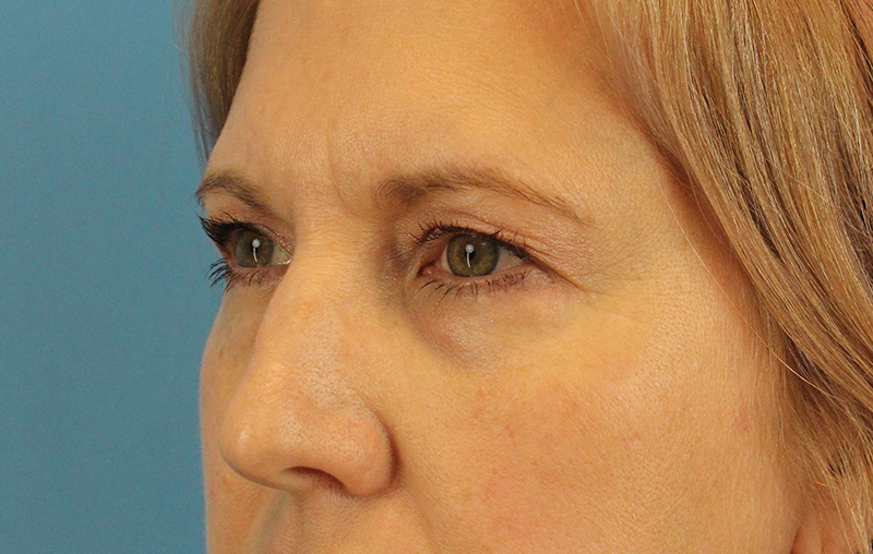 Before - left_oblique