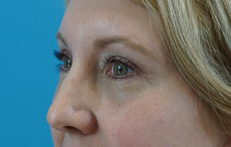 After - left_oblique