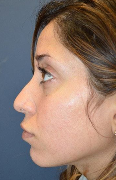 Before - left_lateral