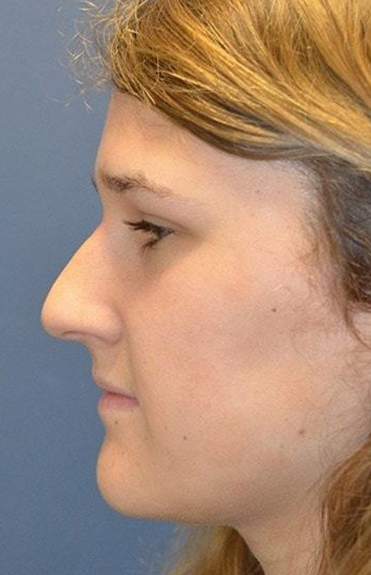 Before - left_lateral