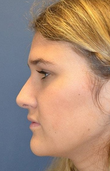 After - left_lateral