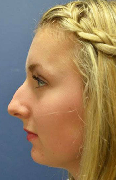 Before - left_lateral