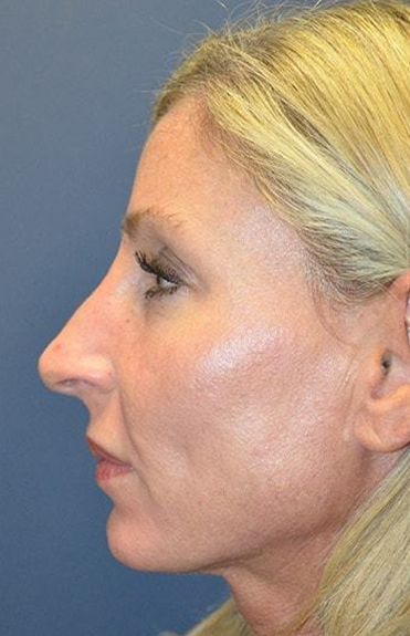 Before - left_lateral