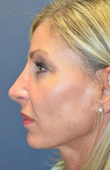 After - left_lateral