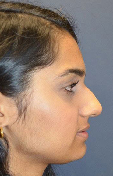 Before - right_lateral