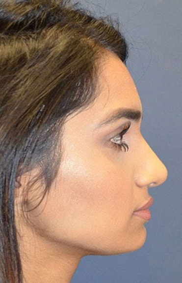 After - right_lateral