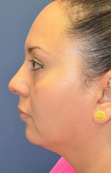 Before - left_lateral