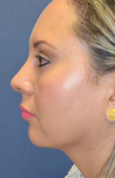 After - left_lateral