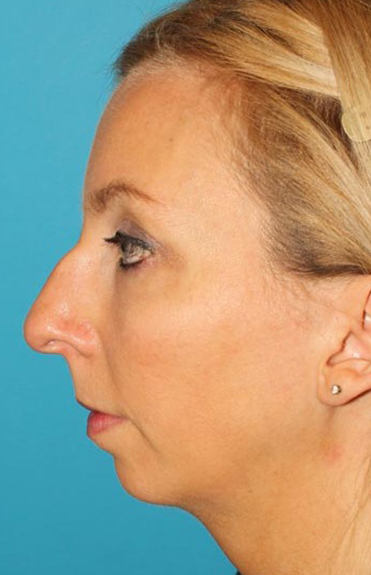 Before - left_lateral