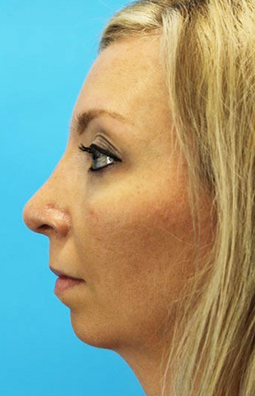 After - left_lateral