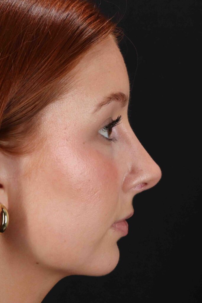 After - right_lateral