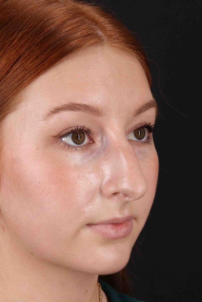 Before - right_oblique