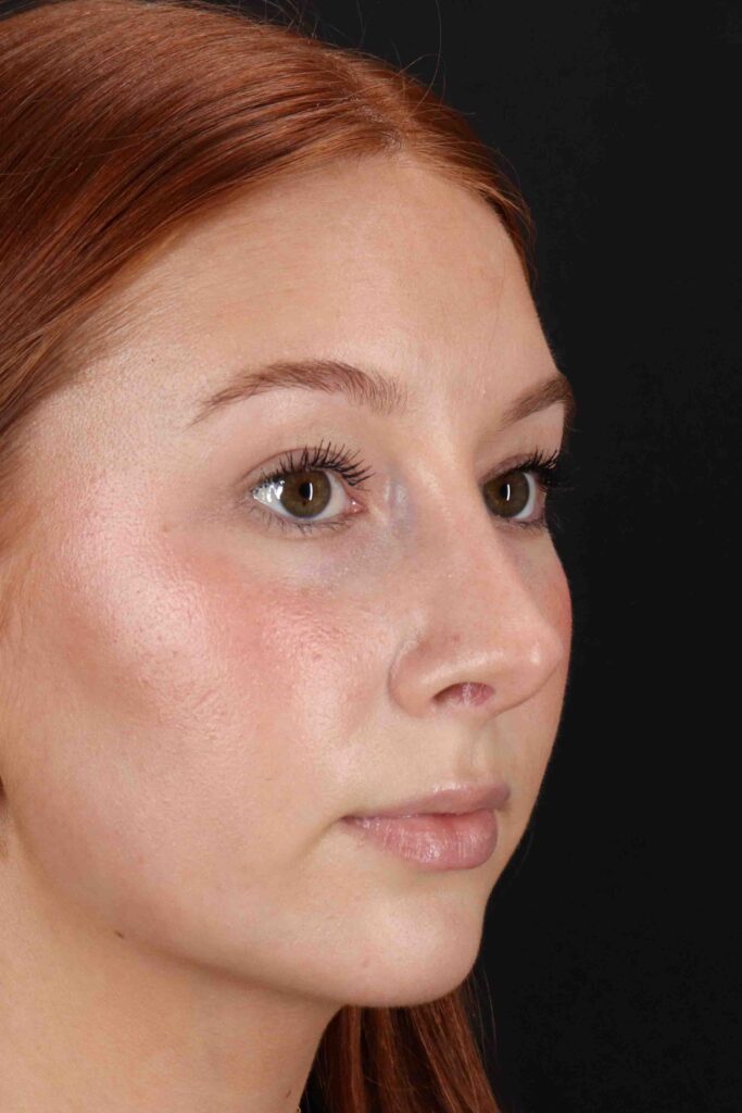 After - right_oblique