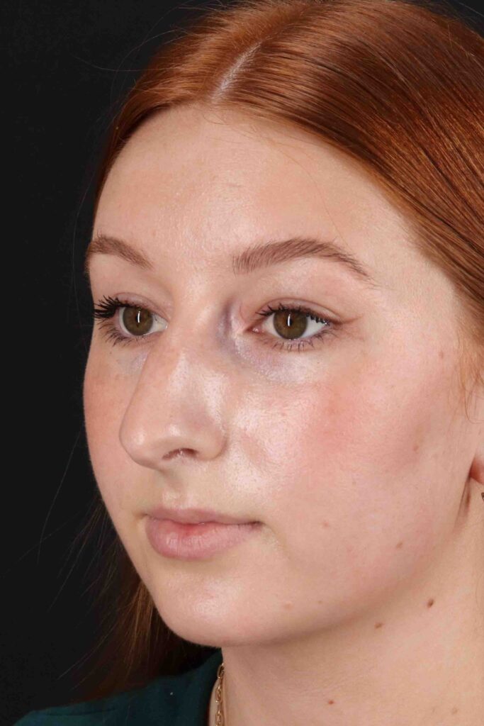 Before - left_oblique