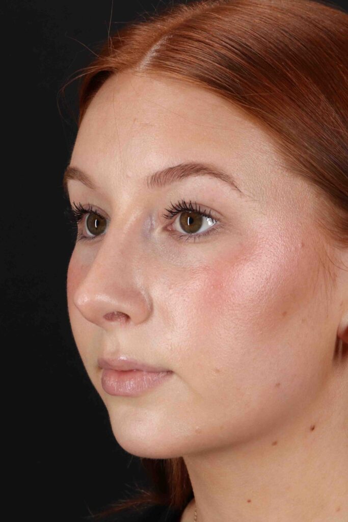 After - left_oblique