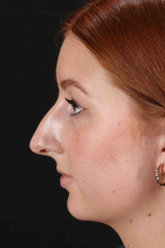 Before - left_lateral