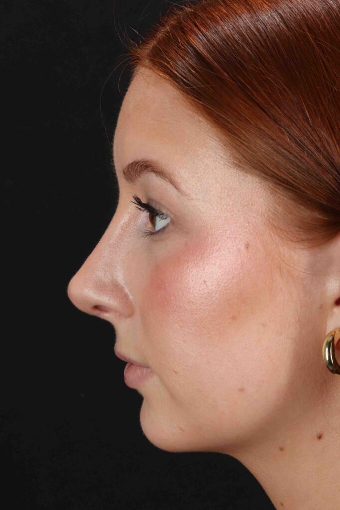 After - left_lateral